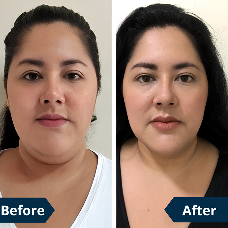 🔥 40% OFF Today – FaceLift™ Double Chin & Wrinkle Remover ✨ Visible Results in 14 Days + FREE Firming Cream 💕